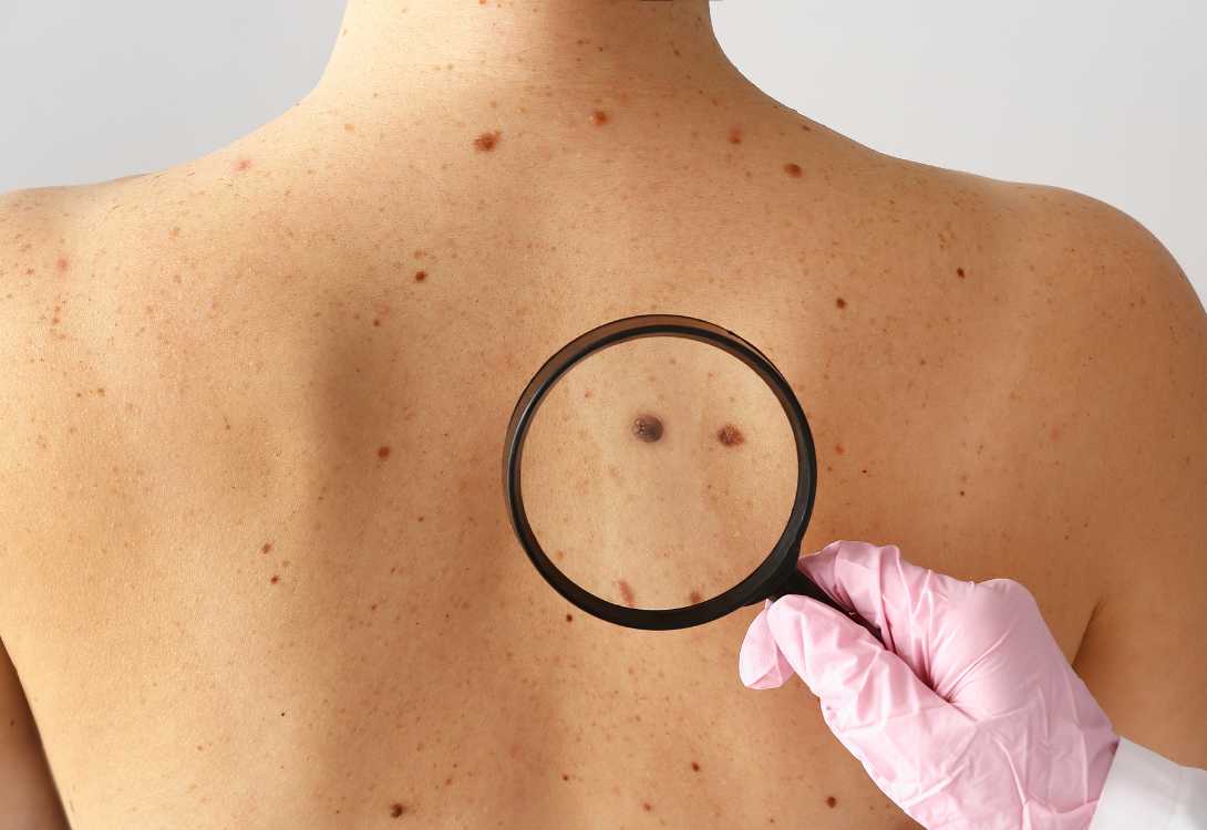 Leia mais sobre o artigo Mutirão de Câncer de Pele vai oferecer pequenas cirurgias em Alfredo Chaves